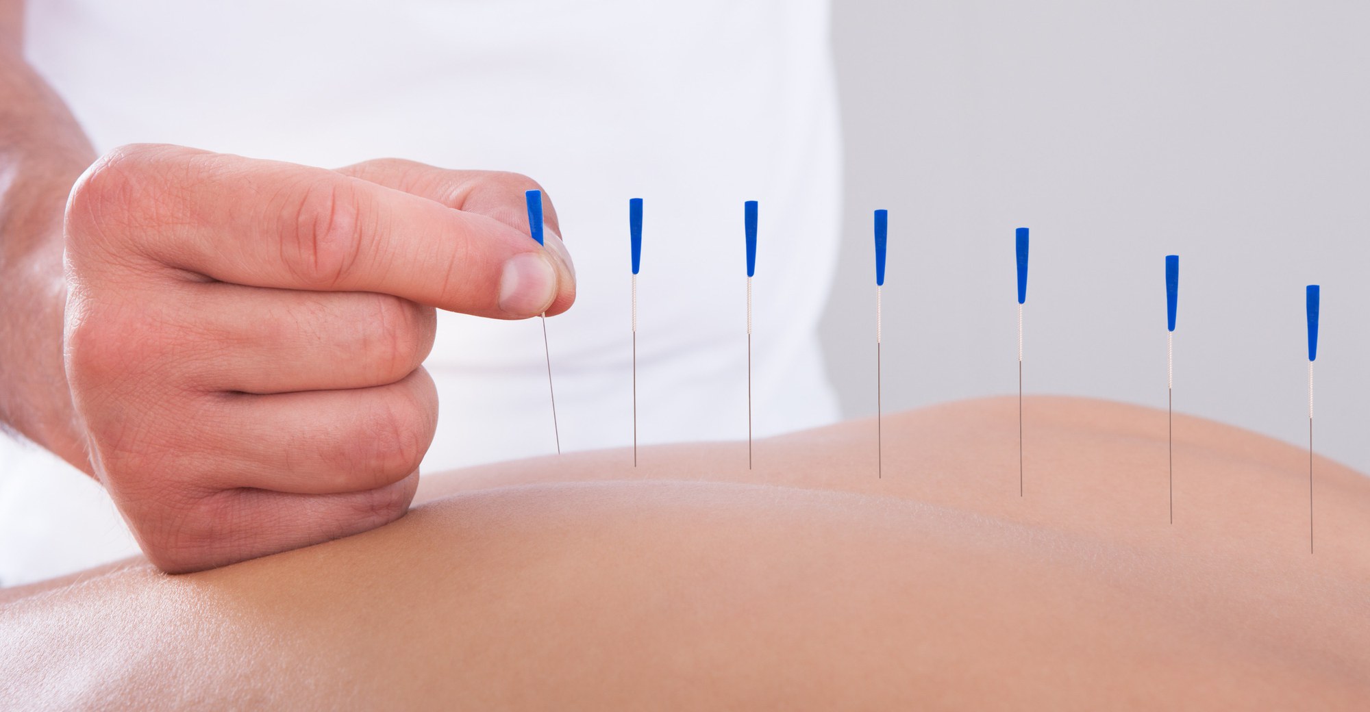 Acupuncturisten